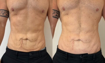 Morpheus8 Before and After Photos in Miami Beach, FL, Patient 14529