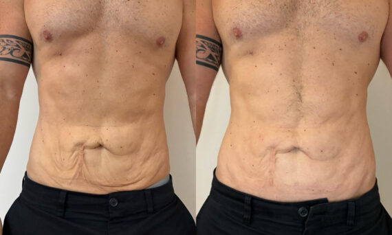 Morpheus8 Before and After Photos in Miami Beach, FL, Patient 14529