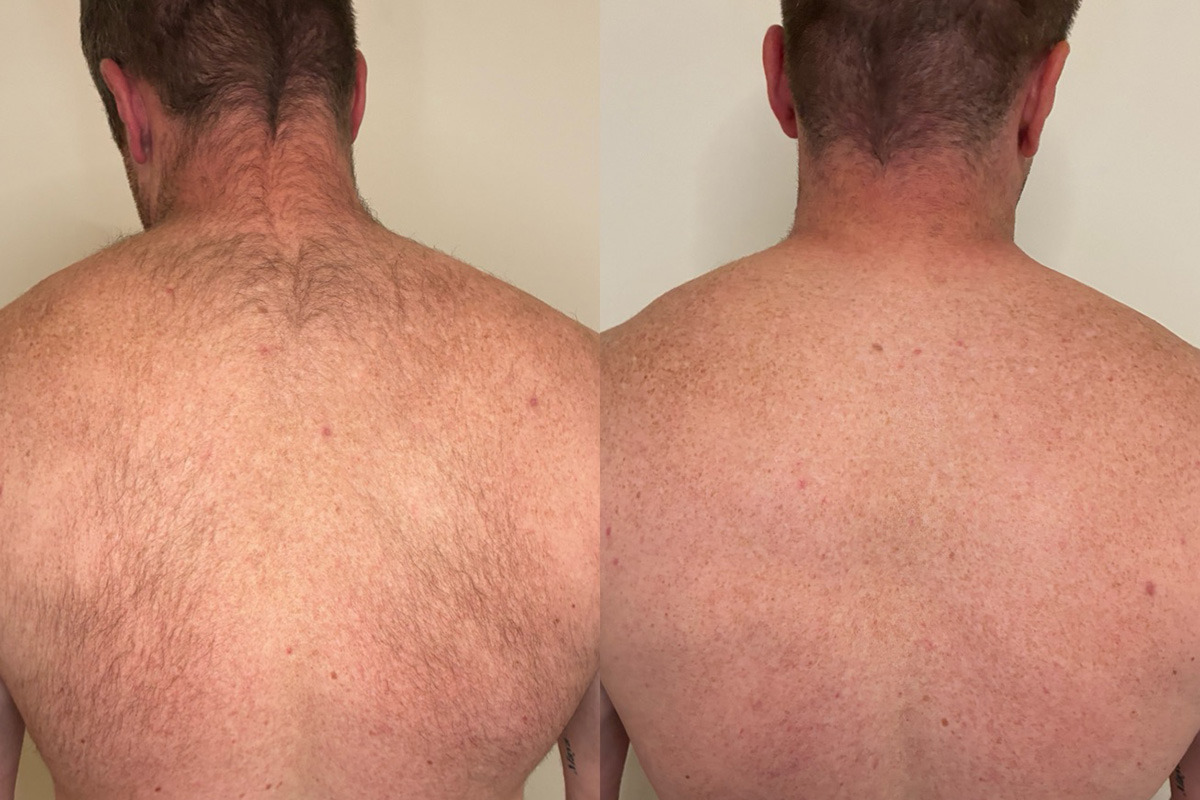 Laser Hair Removal Before and After Photos in Miami Beach, FL, Patient 14824