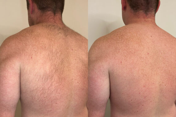 Laser Hair Removal Before and After Photos in Miami Beach, FL, Patient 14824
