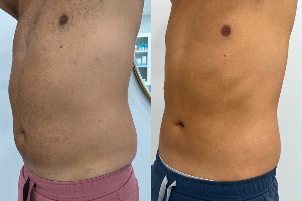 Laser Hair Removal Before and After Photos in Miami Beach, FL, Patient 14845