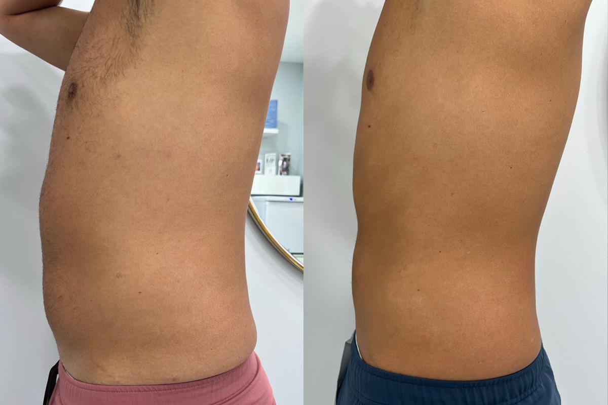 Laser Hair Removal Before and After Photos in Miami Beach, FL, Patient 14845