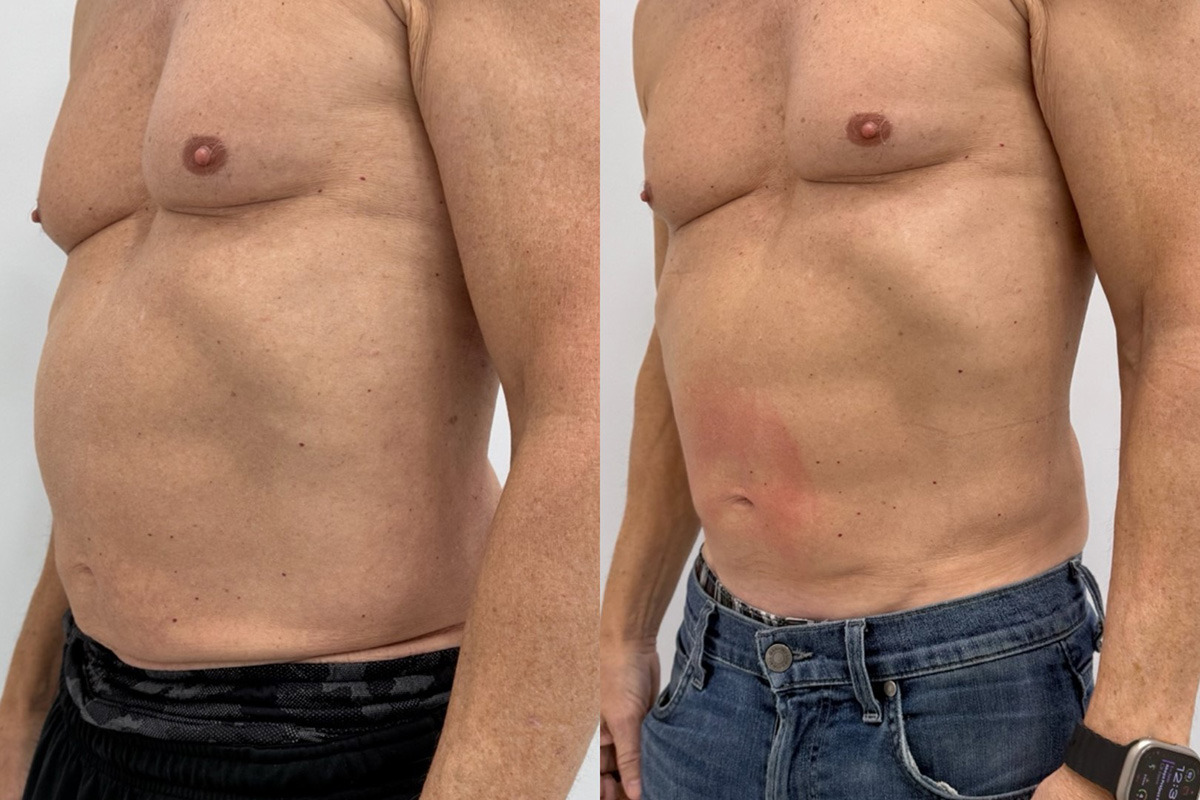 EMSculpt NEO Before and After Photos in Miami Beach, FL, Patient 14850