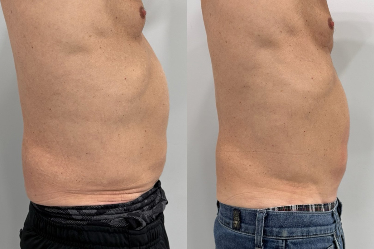 EMSculpt NEO Before and After Photos in Miami Beach, FL, Patient 14850