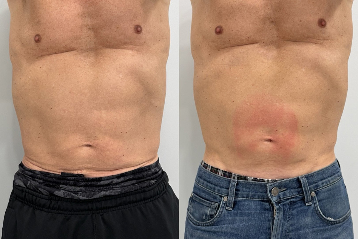 EMSculpt NEO Before and After Photos in Miami Beach, FL, Patient 14850