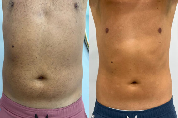EMSculpt NEO Before and After Photos in Miami Beach, FL, Patient 14854