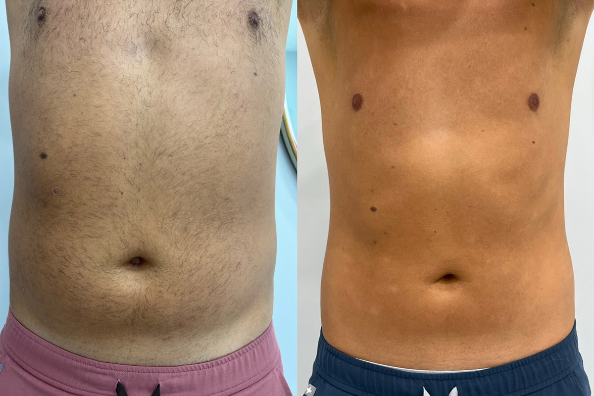 EMSculpt NEO Before and After Photos in Miami Beach, FL, Patient 14854