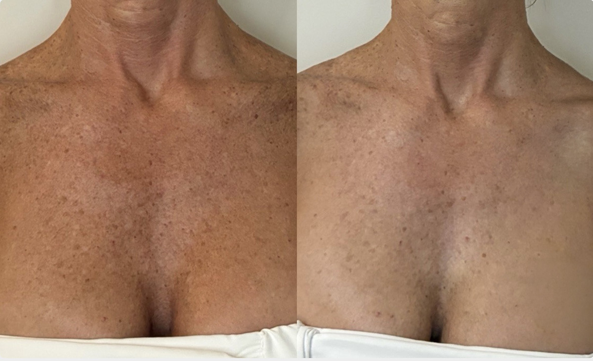 IPL Treatment Before and After Photos in Miami Beach, FL, Patient 14858