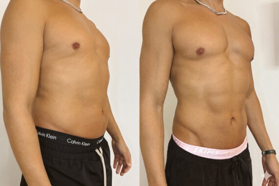EMSculpt NEO Before and After Photos in Miami Beach, FL, Patient 14933
