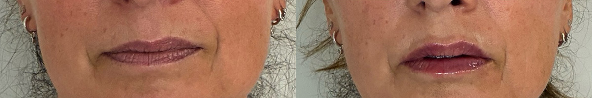 Lip Fillers Before and After Photos in Miami Beach, FL, Patient 14941