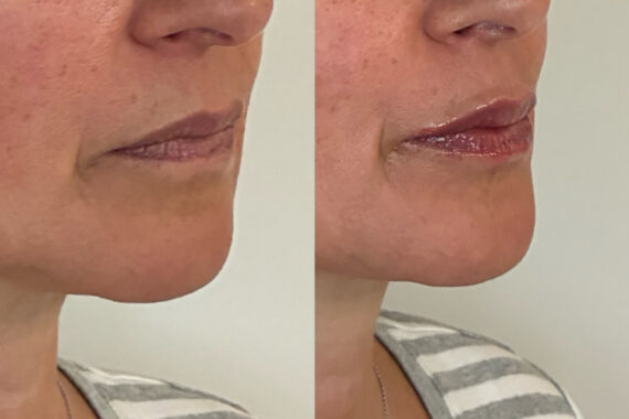 Lip Fillers Before and After Photos in Miami Beach, FL, Patient 14941