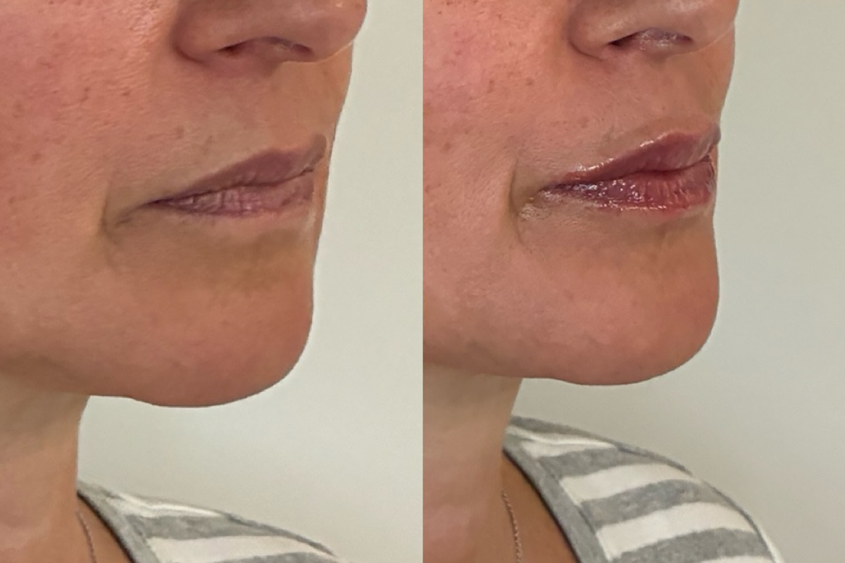 Lip Fillers Before and After Photos in Miami Beach, FL, Patient 14941