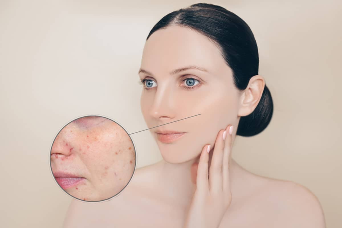 A woman with smooth skin featuring a circular inset that magnifies sunspots and skin imperfections to show areas that require resurfacing.