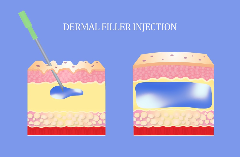 Diagram showing dermal filler injection restoring skin volume with hyaluronic acid for facial rejuvenation