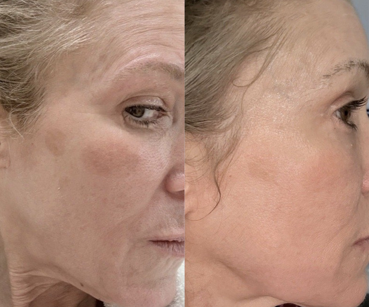 IPL Treatment Before and After Photos in Miami Beach, FL, Patient 15646