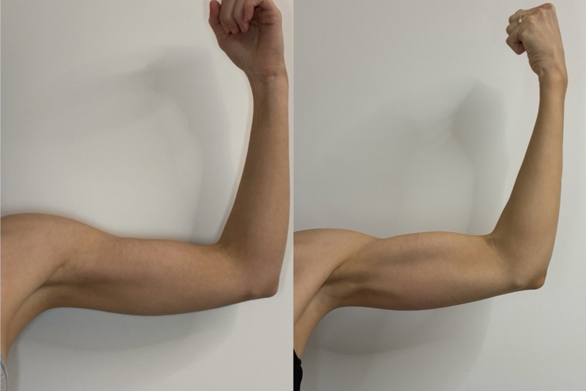 EMSculpt NEO Before and After Photos in Miami Beach, FL, Patient 15685