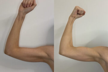 EMSculpt NEO Before and After Photos in Miami Beach, FL, Patient 15685