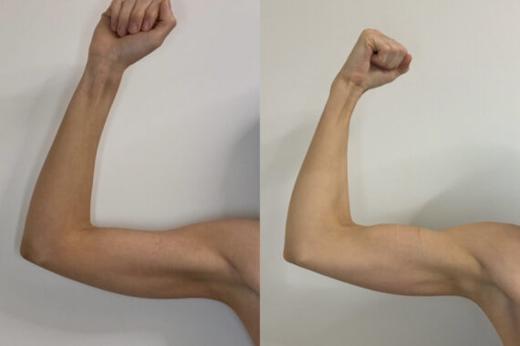 EMSculpt NEO Before and After Photos in Miami Beach, FL, Patient 15685