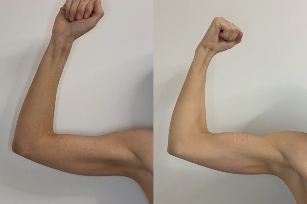 EMSculpt NEO Before and After Photos in Miami Beach, FL, Patient 15685