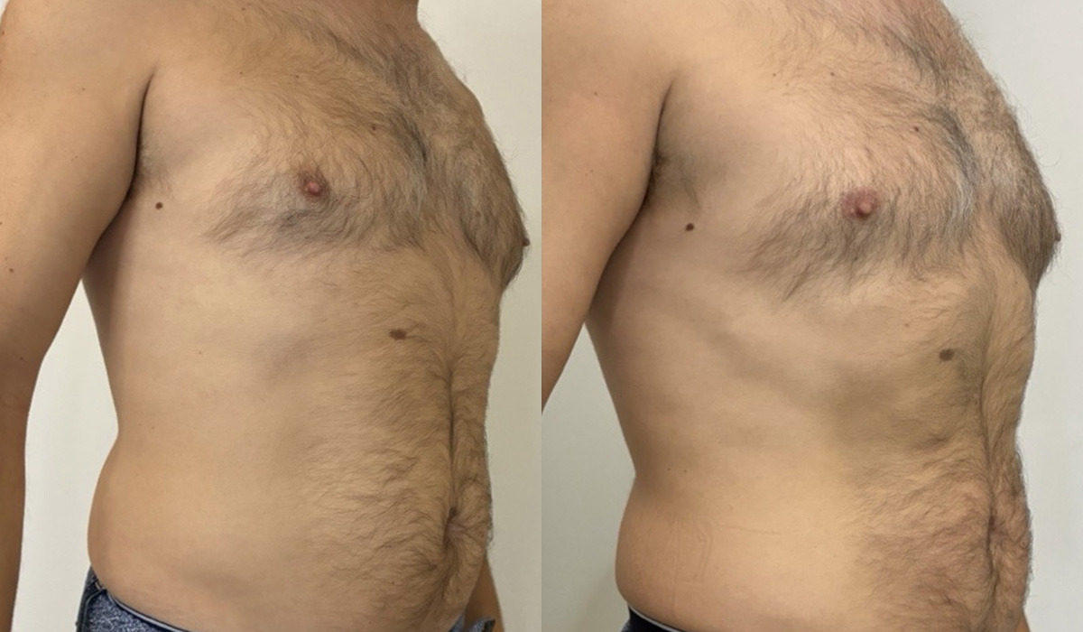 EMSculpt NEO Before and After Photos in Miami Beach, FL, Patient 15688