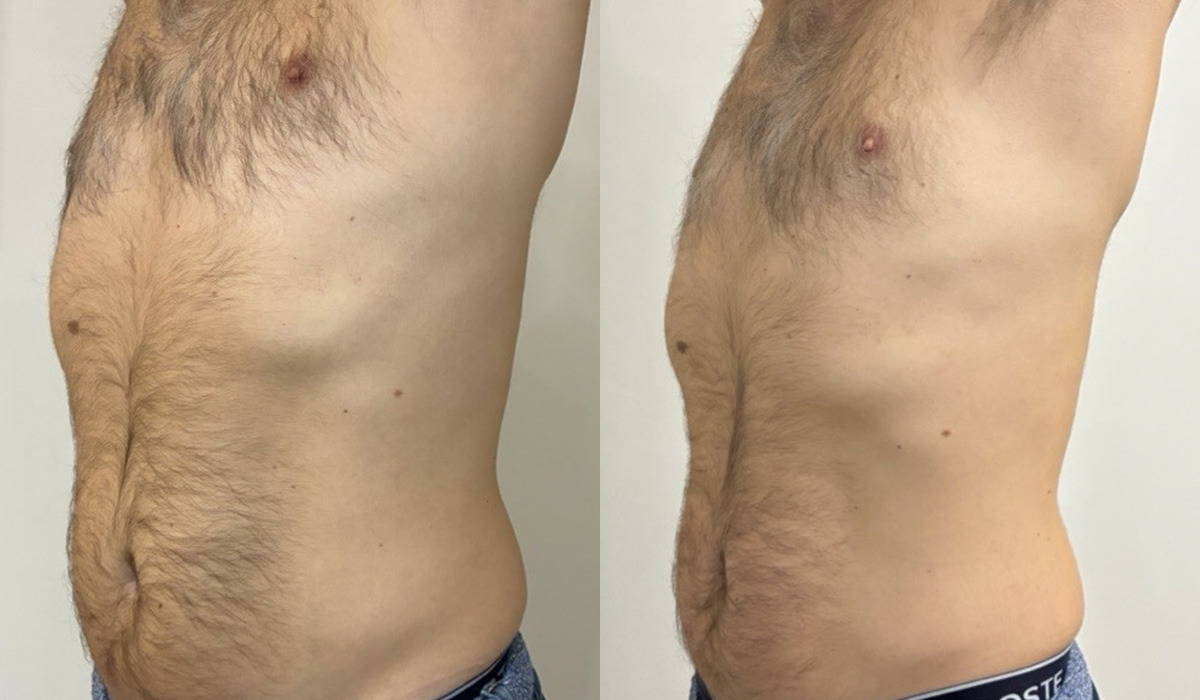 EMSculpt NEO Before and After Photos in Miami Beach, FL, Patient 15688