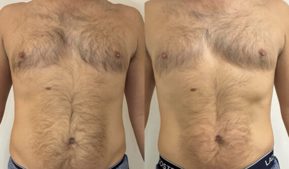 EMSculpt NEO Before and After Photos in Miami Beach, FL, Patient 15688