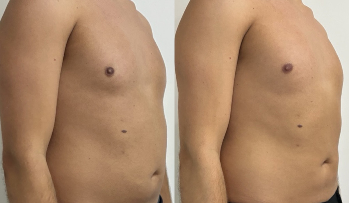 EMSculpt NEO Before and After Photos in Miami Beach, FL, Patient 15692