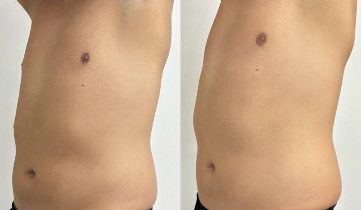 EMSculpt NEO Before and After Photos in Miami Beach, FL, Patient 15692