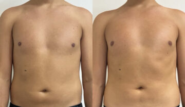 EMSculpt NEO Before and After Photos in Miami Beach, FL, Patient 15692