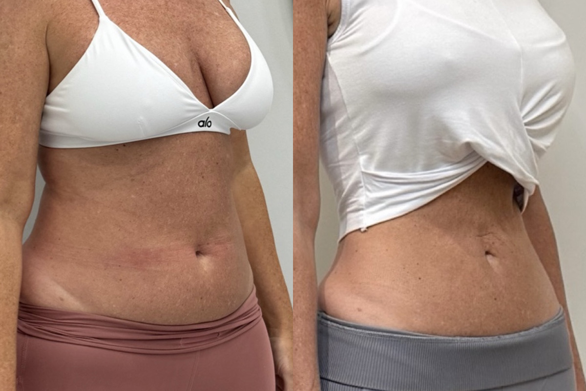 Weight Loss Program Before and After Photos in Miami Beach, FL, Patient 15763