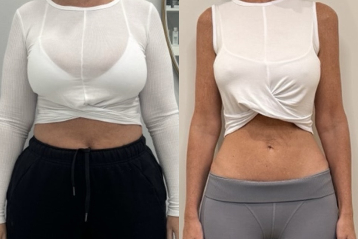 Weight Loss Program Before and After Photos in Miami Beach, FL, Patient 15763