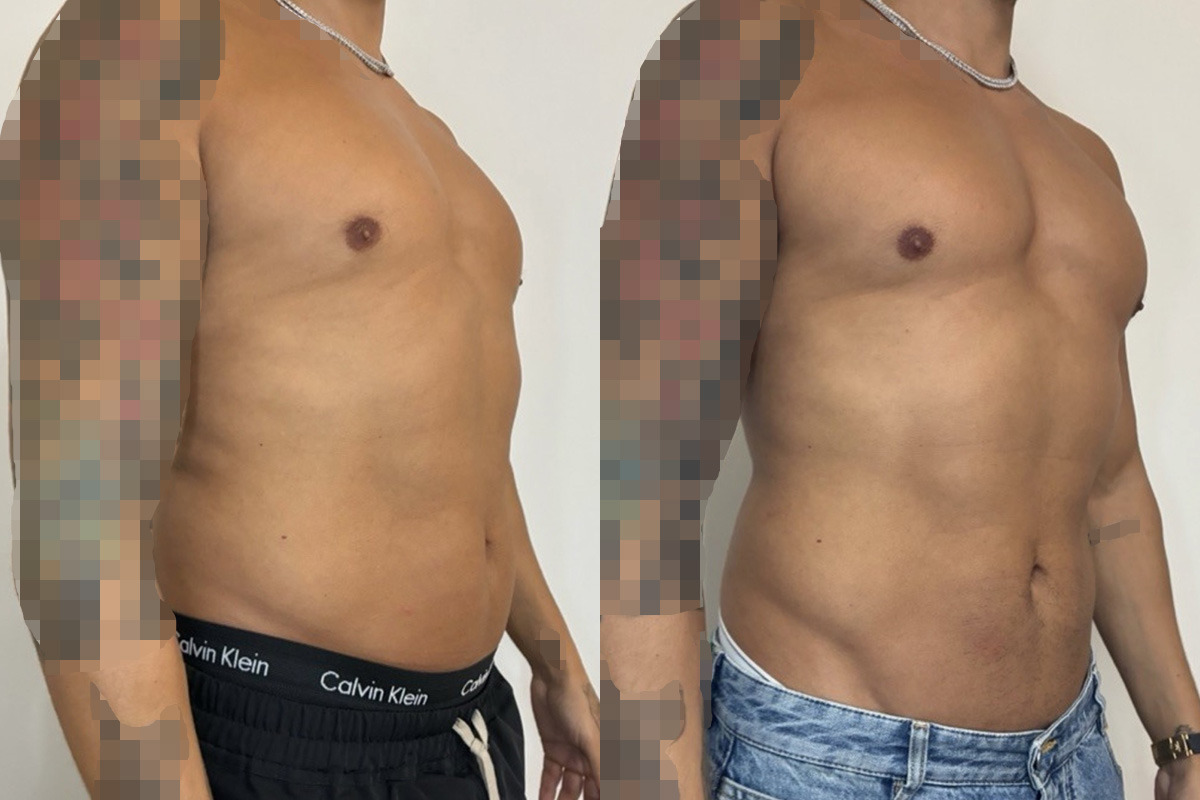 Weight Loss Program Before and After Photos in Miami Beach, FL, Patient 15776