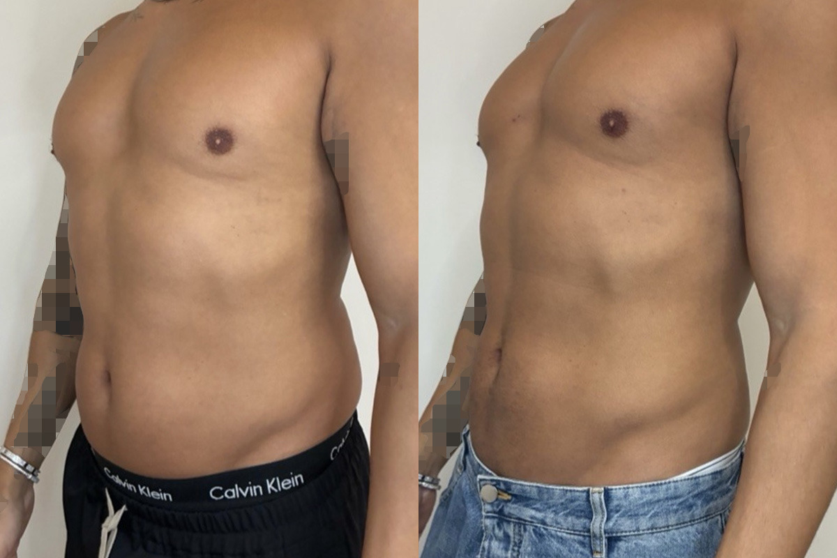Weight Loss Program Before and After Photos in Miami Beach, FL, Patient 15776