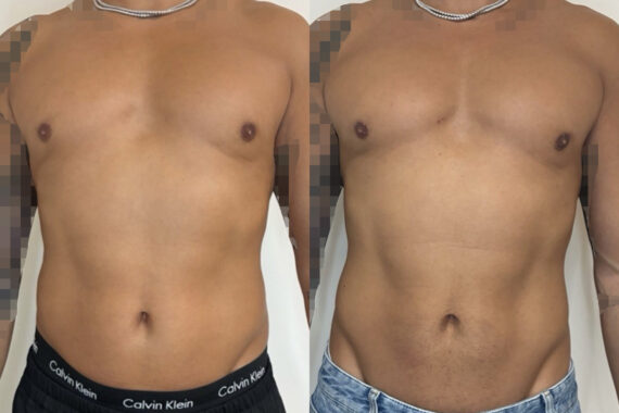 Weight Loss Program Before and After Photos in Miami Beach, FL, Patient 15776