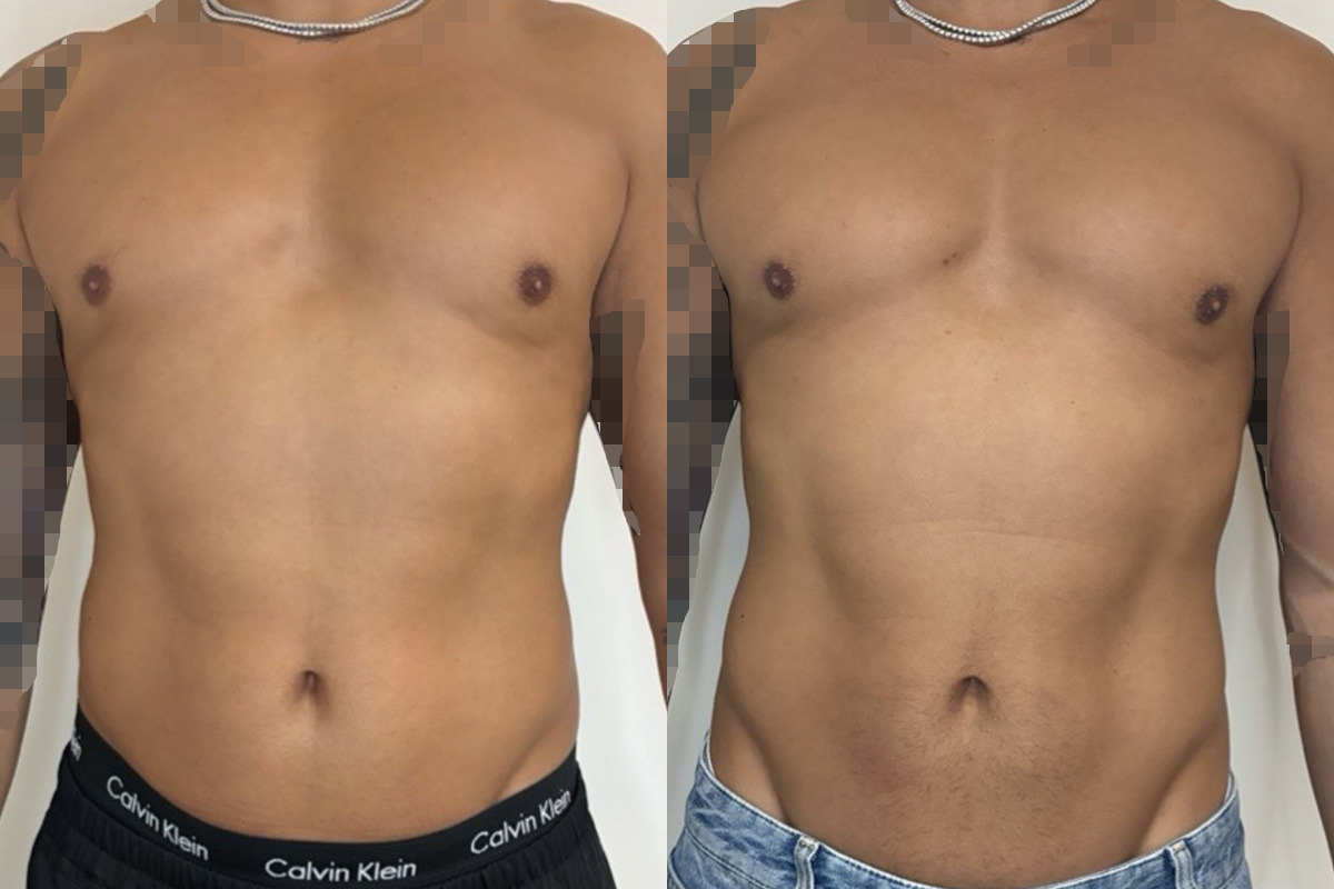 Weight Loss Program Before and After Photos in Miami Beach, FL, Patient 15776