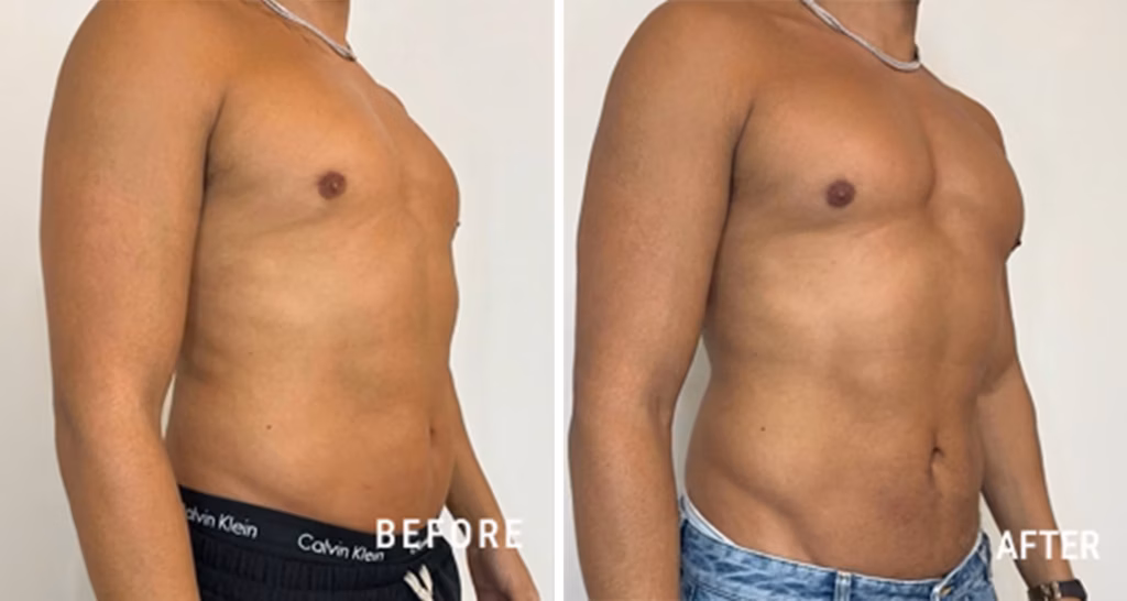 Before-and-after view of a patient’s abdominal area following EMSculpt NEO treatment.