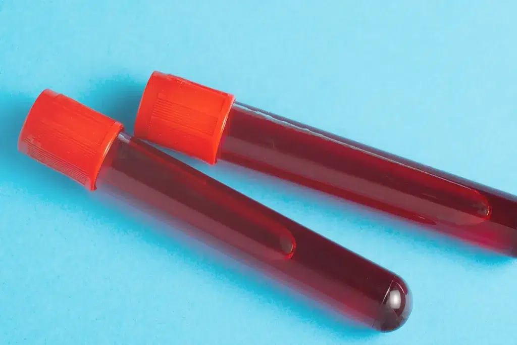 Blood sample tubes used for laboratory testing.